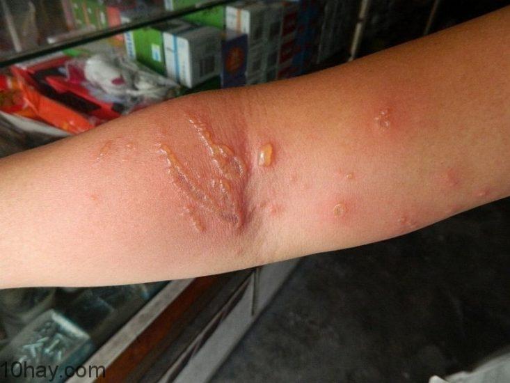 Vết bỏng do sứa cắn