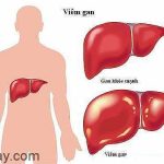 Nguyên nhân các bệnh về gan