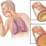 dấu hiệu nhận biết bệnh lao phổi