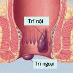 biện pháp phòng bệnh trĩ