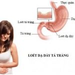 biện pháp phòng bệnh loét dạ dày tá tràng