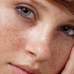 bệnh ngoài da thường gặp vào mùa hè