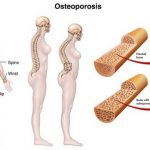 10 cách phòng bệnh loãng xương