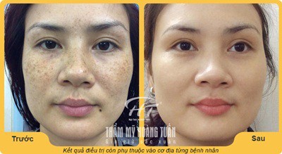 Kết quả điều trị nám tại thẩm mỹ viện Hoàng Tuấn