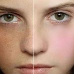 dịch vụ trị nám da uy tín ở TPHCM