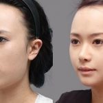 phẩu thuật hàm hô móm tốt nhất tại TPHCM