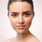 10 thực phẩm giảm thâm mụn hiệu quả